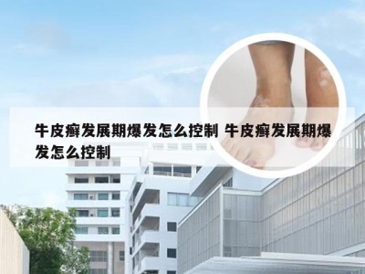 牛皮癣发展期爆发怎么控制 牛皮癣发展期爆发怎么控制