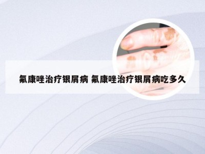 氟康唑治疗银屑病 氟康唑治疗银屑病吃多久
