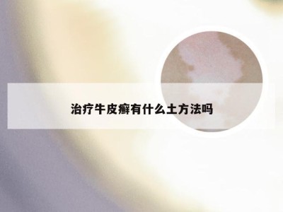 治疗牛皮癣有什么土方法吗