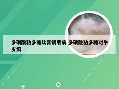 多磺酸粘多糖软膏银屑病 多磺酸粘多糖对牛皮癣