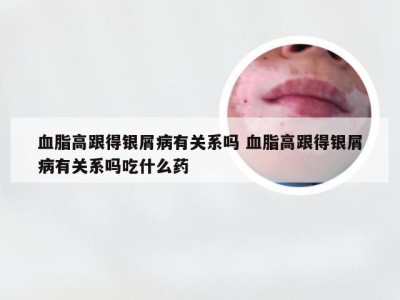 血脂高跟得银屑病有关系吗 血脂高跟得银屑病有关系吗吃什么药