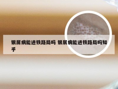 银屑病能进铁路局吗 银屑病能进铁路局吗知乎