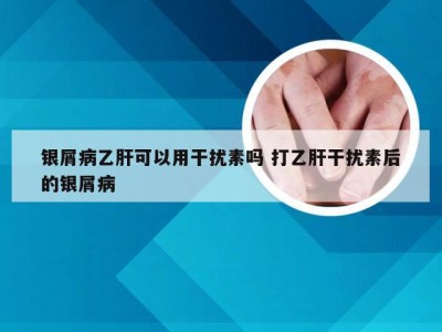 银屑病乙肝可以用干扰素吗 打乙肝干扰素后的银屑病