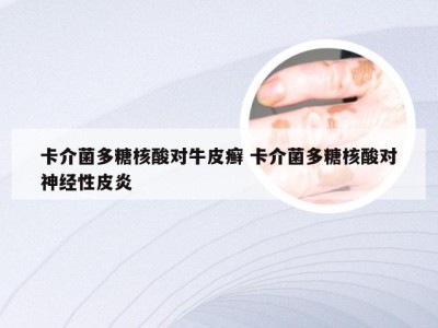 卡介菌多糖核酸对牛皮癣 卡介菌多糖核酸对神经性皮炎