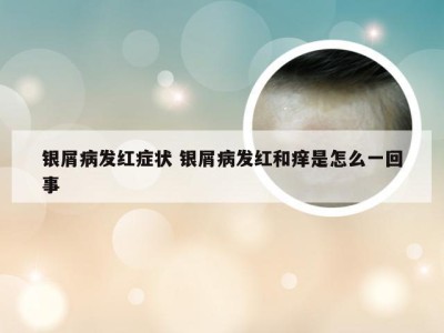 银屑病发红症状 银屑病发红和痒是怎么一回事