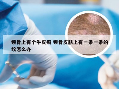 锁骨上有个牛皮癣 锁骨皮肤上有一条一条的纹怎么办