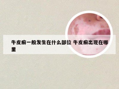 牛皮癣一般发生在什么部位 牛皮癣出现在哪里