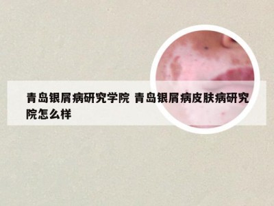 青岛银屑病研究学院 青岛银屑病皮肤病研究院怎么样