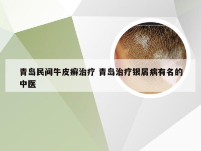 青岛民间牛皮癣治疗 青岛治疗银屑病有名的中医