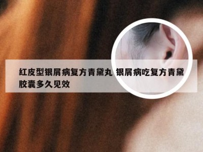 红皮型银屑病复方青黛丸 银屑病吃复方青黛胶囊多久见效
