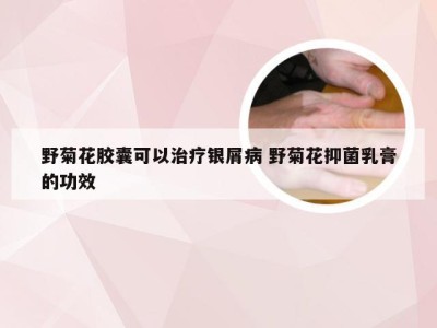 野菊花胶囊可以治疗银屑病 野菊花抑菌乳膏的功效