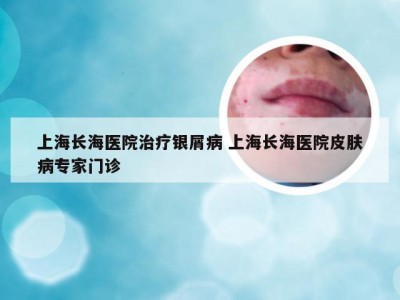 上海长海医院治疗银屑病 上海长海医院皮肤病专家门诊