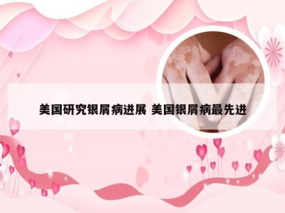 美国研究银屑病进展 美国银屑病最先进