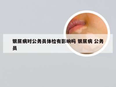 银屑病对公务员体检有影响吗 银屑病 公务员