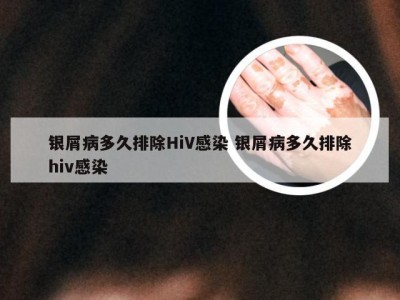 银屑病多久排除HiV感染 银屑病多久排除hiv感染