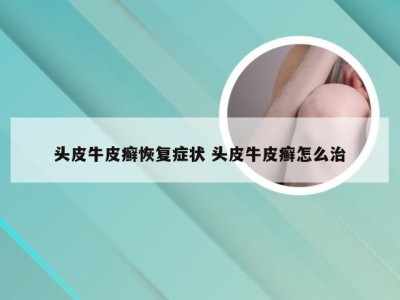 头皮牛皮癣恢复症状 头皮牛皮癣怎么治