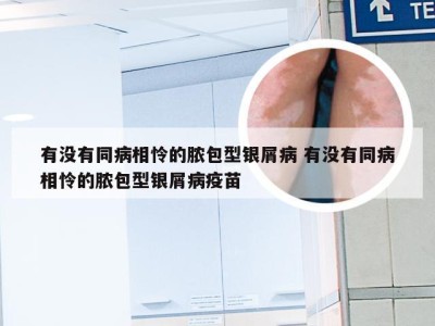 有没有同病相怜的脓包型银屑病 有没有同病相怜的脓包型银屑病疫苗