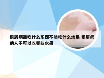 银屑病能吃什么东西不能吃什么水果 银屑病病人不可以吃哪些水果