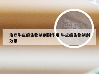 治疗牛皮癣生物制剂副作用 牛皮癣生物制剂效果