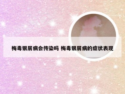 梅毒银屑病会传染吗 梅毒银屑病的症状表现