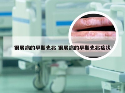 银屑病的早期先兆 银屑病的早期先兆症状