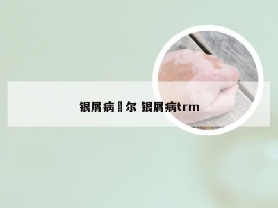 银屑病潽尔 银屑病trm