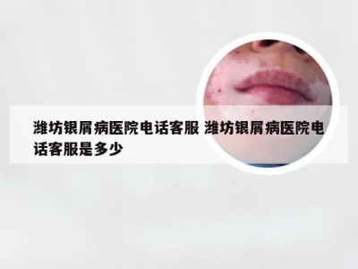 潍坊银屑病医院电话客服 潍坊银屑病医院电话客服是多少
