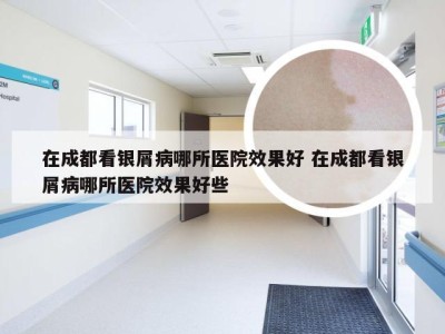 在成都看银屑病哪所医院效果好 在成都看银屑病哪所医院效果好些