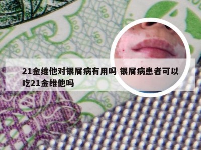 21金维他对银屑病有用吗 银屑病患者可以吃21金维他吗