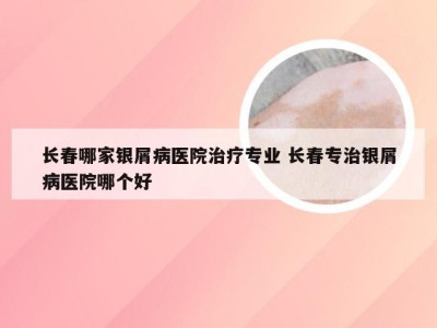 长春哪家银屑病医院治疗专业 长春专治银屑病医院哪个好