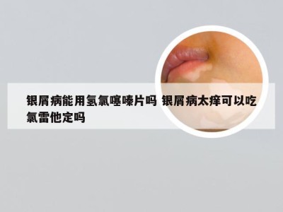 银屑病能用氢氯噻嗪片吗 银屑病太痒可以吃氯雷他定吗