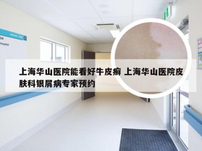 上海华山医院能看好牛皮癣 上海华山医院皮肤科银屑病专家预约