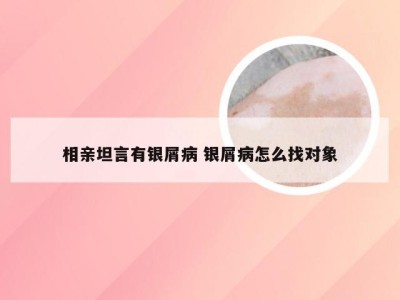 相亲坦言有银屑病 银屑病怎么找对象