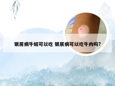 银屑病牛蛙可以吃 银屑病可以吃牛肉吗?
