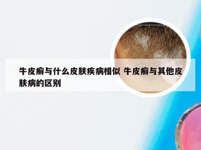 牛皮癣与什么皮肤疾病相似 牛皮癣与其他皮肤病的区别
