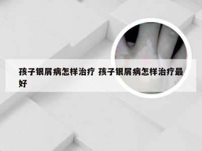 孩子银屑病怎样治疗 孩子银屑病怎样治疗最好