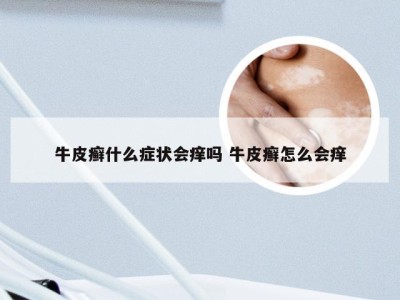 牛皮癣什么症状会痒吗 牛皮癣怎么会痒