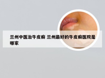 兰州中医治牛皮癣 兰州最好的牛皮癣医院是哪家