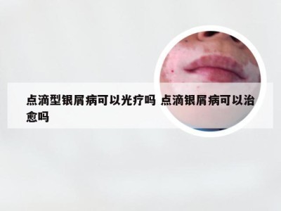 点滴型银屑病可以光疗吗 点滴银屑病可以治愈吗