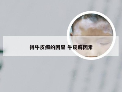 得牛皮癣的因果 牛皮癣因素