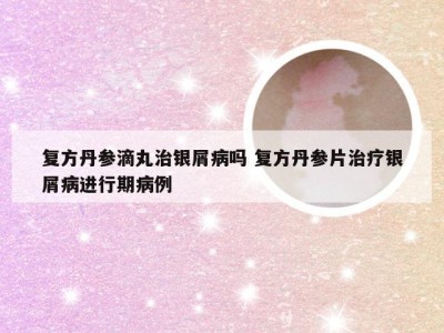 复方丹参滴丸治银屑病吗 复方丹参片治疗银屑病进行期病例