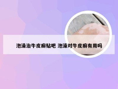 泡澡治牛皮癣贴吧 泡澡对牛皮癣有用吗