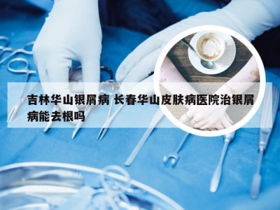 吉林华山银屑病 长春华山皮肤病医院治银屑病能去根吗