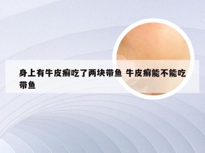 身上有牛皮癣吃了两块带鱼 牛皮癣能不能吃带鱼