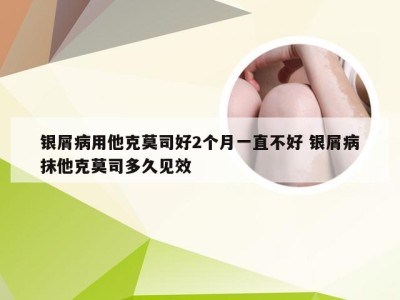 银屑病用他克莫司好2个月一直不好 银屑病抹他克莫司多久见效
