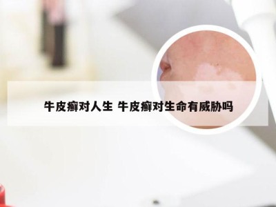 牛皮癣对人生 牛皮癣对生命有威胁吗