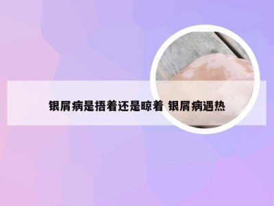 银屑病是捂着还是晾着 银屑病遇热