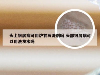 头上银屑病可用炉甘石洗剂吗 头部银屑病可以用洗发水吗