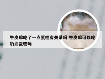 牛皮癣吃了一点蛋糕有关系吗 牛皮癣可以吃奶油蛋糕吗