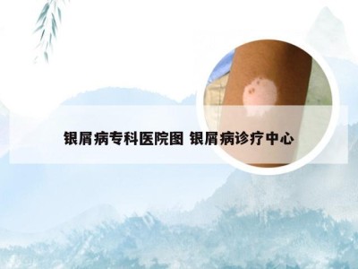 银屑病专科医院图 银屑病诊疗中心